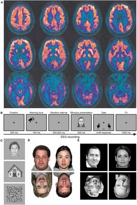 Face Recognition Deficits in a Patient With Alzheimer's Disease: Amnesia or Agnosia? The Importance of Electrophysiological Markers for Differential Diagnosis